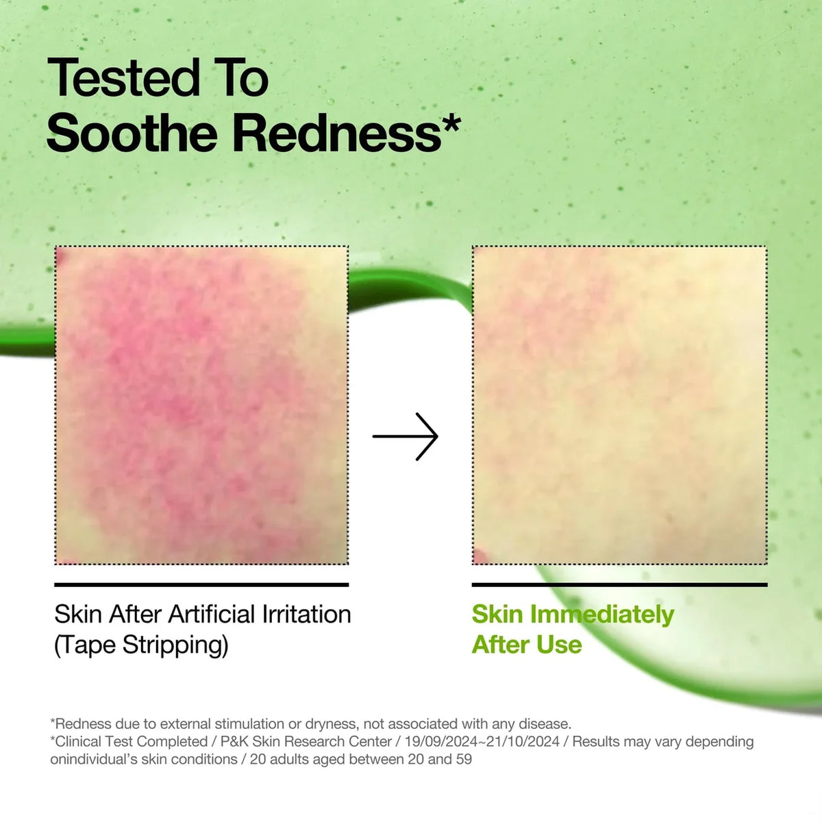 ANUA Azelaic Acid 10% + Hyaluron — Sérum Calmante para Rojeces